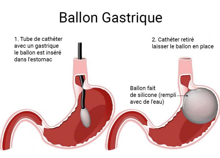 Ballon Gastrique Op. Dr. Mehtap ERTÜRK